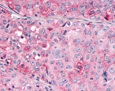 Immunohistochemistry-Paraffin: OR10R2 Antibody [NLS4554] - Analysis of anti-OR10R2 antibody with human ovary, carcinoma.