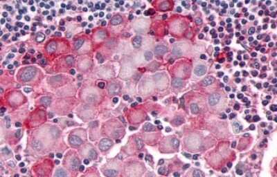 Immunohistochemistry-Paraffin: OR10R2 Antibody [NLS4554] - Anti-OR10R2 antibody IHC of human Skin, Melanoma. Immunohistochemistry of formalin-fixed, paraffin-embedded tissue after heat-induced antigen retrieval.