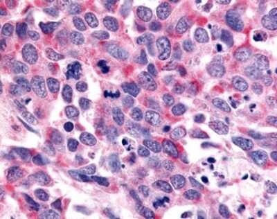 Immunohistochemistry-Paraffin: OR8G2 Antibody [NLS4354] - Analysis of anti-OR6K3 antibody with human lung, small cell carcinoma.