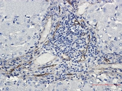 Immunohistochemistry-Paraffin: ORAI3 Antibody (S06-8B3) [NBP3-19901] - Immunohistochemistry of ORAI3 in paraffin-embedded liver cancer tissue using NBP3-19901 at dilution 1/50