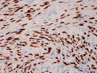 Immunohistochemistry-Paraffin: ORF73/HHV8 Antibody (HHV8/3606) - Azide and BSA Free [NBP3-08645] - Formalin-fixed, paraffin-embedded human Kaposi's sarcoma stained with ORF73/HHV8 Recombinant Mouse Monoclonal Antibody (ORF73/HHV8/3606).
