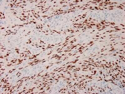 Immunohistochemistry-Paraffin: ORF73/HHV8 Antibody (HHV8/3633R) - Azide and BSA Free [NBP3-08397] - Formalin-fixed, paraffin-embedded human Kaposi's sarcoma stained with ORF73/HHV8 Recombinant Rabbit Monoclonal Antibody (ORF73/HHV8/3633R).