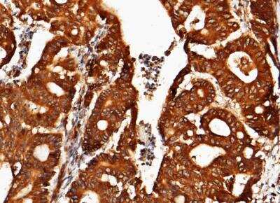 Immunohistochemistry-Paraffin: ORP150/HSP12A Antibody (201) [NBP2-89890] - Staining of human HSP12A in human colon carcinoma with rabbit monoclonal antibody (1:200).