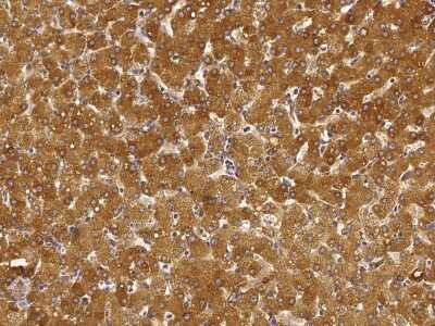 Immunohistochemistry-Paraffin: ORP150/HSP12A Antibody [NBP2-99781] - Immunochemical staining of human ORP150/HSP12A in human breast carcinoma with rabbit polyclonal antibody (1:5000, formalin-fixed paraffin embedded sections).