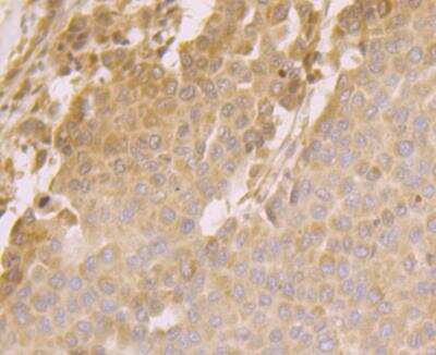 Immunohistochemistry: ORP150/HSP12A Antibody (JG39-11) [NBP2-76858] - Immunohistochemical analysis of paraffin-embedded human liver cancer tissue using anti-ORP150 antibody. Counter stained with hematoxylin.