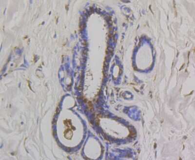 Immunohistochemistry-Paraffin: OS9 Antibody (JG38-07) [NBP2-75602] - Analysis of paraffin-embedded human breast cancer tissue using anti-OS9 antibody. Counter stained with hematoxylin.