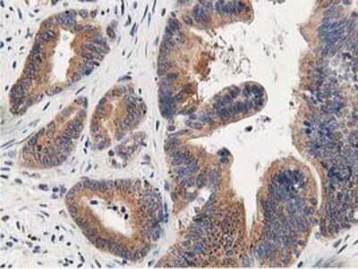 Immunohistochemistry-Paraffin: OSBP1 Antibody (1F2) [NBP2-00935] - Staining of paraffin-embedded Adenocarcinoma of Human colon tissue using anti-OSBP1 mouse monoclonal antibody.