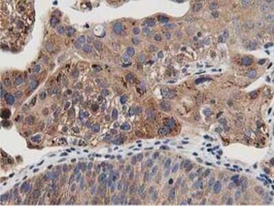 Immunohistochemistry-Paraffin: OSBP1 Antibody (1F2) [NBP2-00935] - Staining of paraffin-embedded Carcinoma of Human bladder tissue using anti-OSBP1 mouse monoclonal antibody.