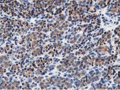 Immunohistochemistry-Paraffin: OSBP1 Antibody (1F2) [NBP2-00935] - Staining of paraffin-embedded Carcinoma of Human thyroid tissue using anti-OSBP1 mouse monoclonal antibody.