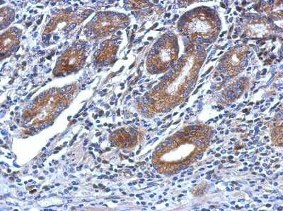 Immunohistochemistry-Paraffin: OSBP2 Antibody [NBP2-19635] - Analysis of paraffin-embedded human colon carcinoma, using OSBP2 antibody at 1:500 dilution.  Antigen Retrieval: Trilogy™ (EDTA based, pH 8.0) buffer, 15min