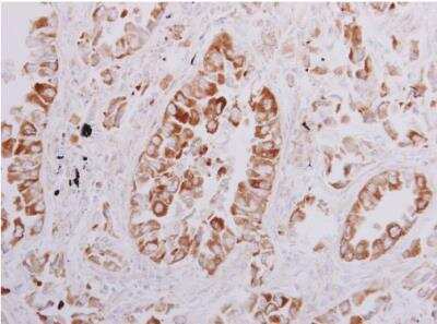 Immunohistochemistry-Paraffin: OSBPL6 Antibody [NBP1-31456] -  Human lung adenocarcinoma. OSBPL6 antibody [C3], C-term diluted at 1:500. Antigen Retrieval: Trilogy™ (EDTA based, pH 8.0) buffer, 15min. 