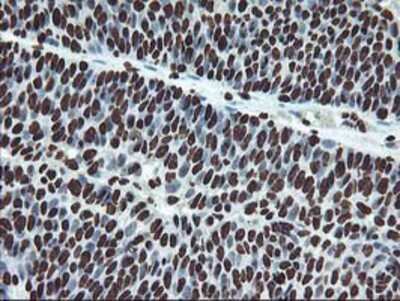 Immunohistochemistry-Paraffin: OSGEP Antibody (9E3) [NBP2-00823] - Staining of paraffin-embedded Carcinoma of Human bladder tissue using anti-OSGEP mouse monoclonal antibody.