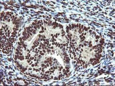 Immunohistochemistry: OSGEP Antibody (OTI9E3) - Azide and BSA Free [NBP2-73163] - Staining of paraffin-embedded Adenocarcinoma of Human endometrium tissue using anti-OSGEP mouse monoclonal antibody.