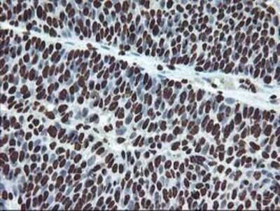 Immunohistochemistry: OSGEP Antibody (OTI9E3) - Azide and BSA Free [NBP2-73163] - Staining of paraffin-embedded Carcinoma of Human bladder tissue using anti-OSGEP mouse monoclonal antibody.