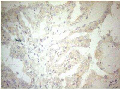 Immunohistochemistry-Paraffin: OSGIN2 Antibody (OTI7D12) [NBP2-46302] - Staining of paraffin-embedded Carcinoma of Human thyroid tissue using anti-OSGIN2 mouse monoclonal antibody.(Heat-induced epitope retrieval by 1mM EDTA in 10mM Tris buffer (pH8.5) at 120 degrees C for 3 min,)(1:150)