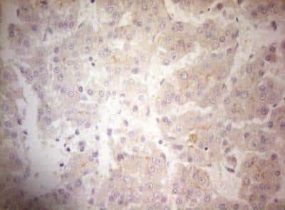 Immunohistochemistry-Paraffin: OSGIN2 Antibody (OTI7D12) [NBP2-46302] -  Staining of paraffin-embedded Carcinoma of Human liver tissue using anti-OSGIN2 mouse monoclonal antibody.(Heat-induced epitope retrieval by 1mM EDTA in 10mM Tris buffer (pH8.5) at 120 degrees C for 3 min,)(1:150)