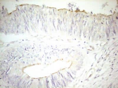 Immunohistochemistry-Paraffin: OSGIN2 Antibody (OTI7D12) [NBP2-46302] - Staining of paraffin-embedded Adenocarcinoma of Human colon tissue using antiOSGIN2 mouse monoclonal antibody. (Heat-inducedepitope retrieval by 1mM EDTA in 10mM Tris buffer (pH8.5) at 120 degrees C for 3 min,)(1:150)