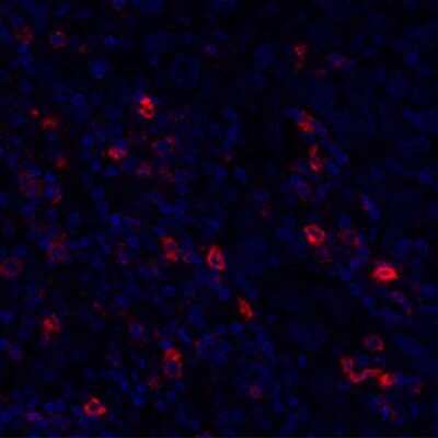 Immunocytochemistry/Immunofluorescence: OX40/TNFRSF4 Antibody (BLR042F) [NBP2-76421] - Detection of human OX40/CD134 (red) in FFPE breast carcinoma by IHC-IF. Antibody: Rabbit anti-OX40/CD134 recombinant monoclonal [BLR042F] (NBP2-76421). Secondary: HRP-conjugated goat anti-rabbit IgG. Substrate: Opal™. Counterstain: DAPI (blue).