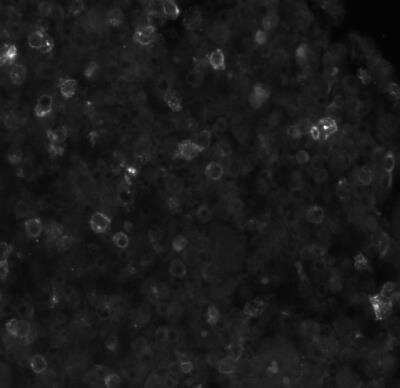 Immunohistochemistry-Paraffin: OX40/TNFRSF4 Antibody (Ber-ACT35) [NBP2-62202] - Human classic Hodgkin's lymphoma stained with OX40 (clone Ber-ACT35) at dilution 1:50, pH9 heat-induced epitope retrieval.  Image from verified customer review.