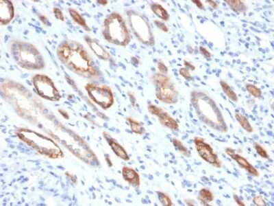 Immunohistochemistry-Paraffin: Occludin Antibody (OCLN/2181) - Azide and BSA Free [NBP3-08879] - Formalin-fixed, paraffin-embedded human Renal Cell Carcinoma stained with Occludin Mouse Monoclonal Antibody (OCLN/2181).