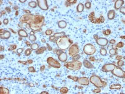 Immunohistochemistry-Paraffin: Occludin Antibody (OCLN/2181) - Azide and BSA Free [NBP3-08879] - Formalin-fixed, paraffin-embedded human thyroid carcinoma stained with Occludin Mouse Monoclonal Antibody (OCLN/2181).