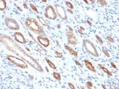 Immunohistochemistry-Paraffin: Occludin Antibody (OCLN/2181) [NBP3-07137] - Formalin-fixed, paraffin-embedded human Renal Cell Carcinoma stained with Occludin Mouse Monoclonal Antibody (OCLN/2181).