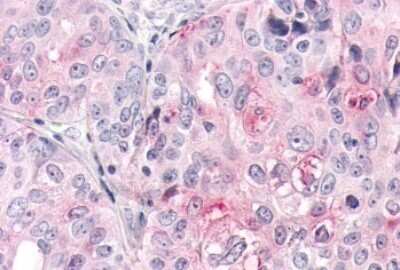 Immunohistochemistry-Paraffin: Olfactory Receptor OR2A4 Antibody [NLS3903] - Anti-OR2A4 antibody IHC of human Ovary, Carcinoma. Immunohistochemistry of formalin-fixed, paraffin-embedded tissue after heat-induced antigen retrieval.