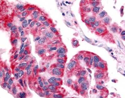 Immunohistochemistry-Paraffin: Olfactory Receptor OR6N1 Antibody [NLS3227] - Analysis of anti-OR6N1 antibody with human lung, non-small cell carcinoma.