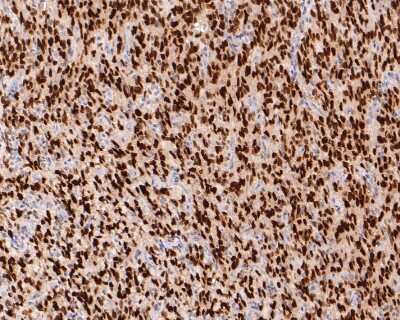 Immunohistochemistry-Paraffin: Olig2 Antibody (SP07-02) [NBP2-67377] - Analysis of paraffin-embedded human glioma tissue using anti-Olig2 antibody.  The section was pre-treated using heat mediated antigen retrieval with sodium citrate buffer (pH 6.0) for 20 minutes. The tissues were blocked in 1% BSA for 30 minutes at room temperature, washed with ddH2O and PBS, and then probed with the primary antibody (1/400) for 30 minutes at room temperature. The detection was performed using an HRP conjugated compact polymer system. DAB was used as the chromogen. Tissues were counterstained with hematoxylin and mounted with DPX.