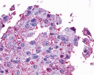 Immunohistochemistry-Paraffin: Opsin 5 Antibody [NLS2144] - Analysis of anti-OPN5 antibody with human ovary, carcinoma.