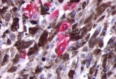 Immunohistochemistry-Paraffin: Opsin 5 Antibody [NLS2144] - Anti-OPN5 antibody IHC of human Skin, Melanoma. Immunohistochemistry of formalin-fixed, paraffin-embedded tissue after heat-induced antigen retrieval.