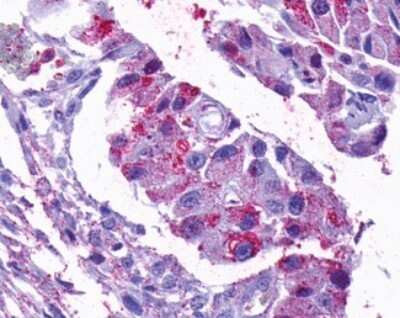 Immunohistochemistry-Paraffin: Opsin 5 Antibody [NLS2146] - Analysis of anti-OPN5 antibody with human ovary, carcinoma.