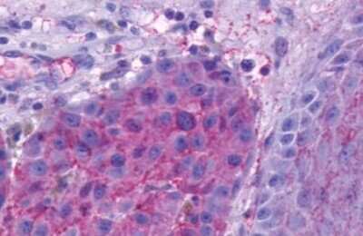 Immunohistochemistry-Paraffin: Opsin 5 Antibody [NLS2146] - Anti-OPN5 antibody IHC of human Skin, Melanoma. Immunohistochemistry of formalin-fixed, paraffin-embedded tissue after heat-induced antigen retrieval.