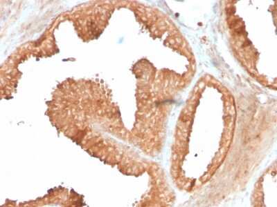 Immunohistochemistry-Paraffin: Ornithine Decarboxylase Antibody (ODC1/3636R) [NBP3-07471] - Formalin-fixed, paraffin-embedded human prostate carcinoma stained with Ornithine Decarboxylase Recombinant Rabbit Monoclonal Antibody (ODC1/3636R).