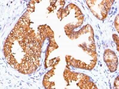 Immunohistochemistry-Paraffin: Ornithine Decarboxylase Antibody (ODC1/485) - IHC-Prediluted [NBP2-44732] - Formalin-fixed, paraffin-embedded human prostate carcinoma with ODC-1 Monoclonal Antibody (ODC1/485)