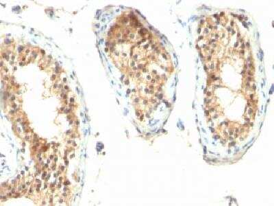 Immunohistochemistry-Paraffin: Ornithine Decarboxylase Antibody (ODC1/485) [NBP2-32887] - Formalin-fixed, paraffin-embedded human Testicular carcinoma with ODC-1 Monoclonal Antibody (ODC1/485)