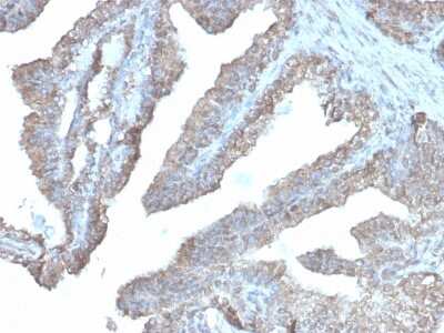 Immunohistochemistry-Paraffin: Ornithine Decarboxylase Antibody (rODC1/485) - Azide and BSA Free [NBP3-08785] - Formalin-fixed, paraffin-embedded human prostate carcinoma stained with Ornithine Decarboxylase Recombinant Mouse Monoclonal Antibody (rODC1/485).
