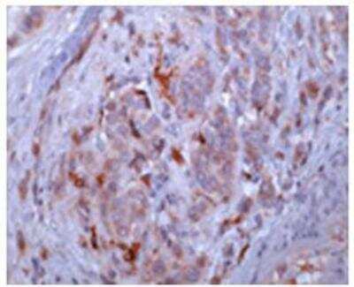Immunohistochemistry-Paraffin: Osteopontin/OPN Antibody (53) [NBP1-19184] - Analysis of formalin-fixed, paraffin-embedded breast cancer tissue stained with 2 ug/ml anti-Osteopontin (53).