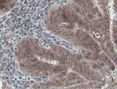 Immunohistochemistry: Otubain-1 Antibody (OTI5B8) [NBP2-45879] - Analysis of Adenocarcinoma of Human endometrium tissue.