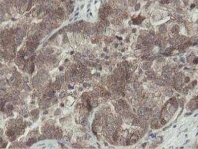 Immunohistochemistry: Otubain-1 Antibody (OTI5B8) [NBP2-45879] - Analysis of Adenocarcinoma of Human ovary tissue.