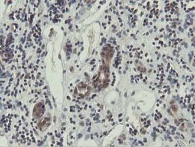 Immunohistochemistry: Otubain-1 Antibody (OTI5B8) [NBP2-45879] - Analysis of Carcinoma of Human kidney tissue.