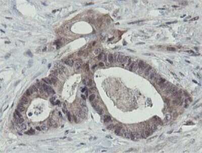 Immunohistochemistry: Otubain-1 Antibody (OTI5B8) [NBP2-45879] - Analysis of Adenocarcinoma of Human colon tissue.