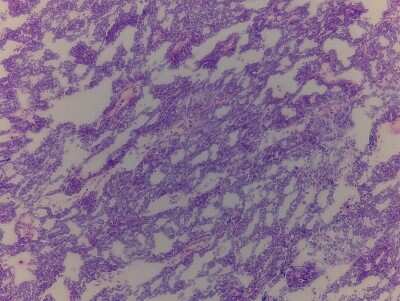 Hematoxylin & Eosin Stain: Ovary Tissue Slides (Tumor) [NBP2-77641] - Tissue: Ovary, Human, Tumorous