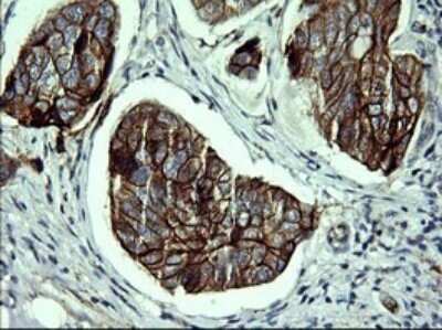 Immunohistochemistry: P-Cadherin Antibody (OTI2D5) [NBP2-45601] - Analysis of Adenocarcinoma of Human breast tissue. (Heat-induced epitope retrieval by 10mM citric buffer, pH6.0, 120C for 3min)