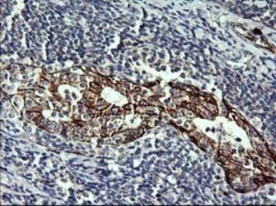 Immunohistochemistry: P-Cadherin Antibody (OTI2D5) [NBP2-45601] - Analysis of Human lymphoma tissue. (Heat-induced epitope retrieval by 10mM citric buffer, pH6.0, 120C for 3min)