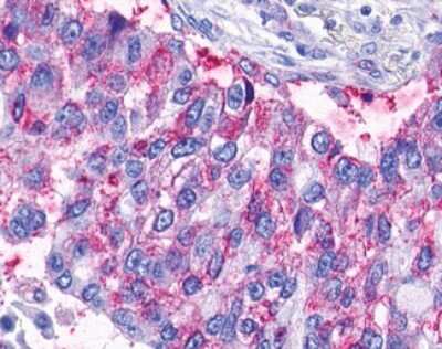 Immunohistochemistry-Paraffin: LPAR6/P2RY5 Antibody [NLS850] -  Analysis of anti-LPAR6 / P2RY5 / P2Y5 antibody with human lung, adenocarcinoma.