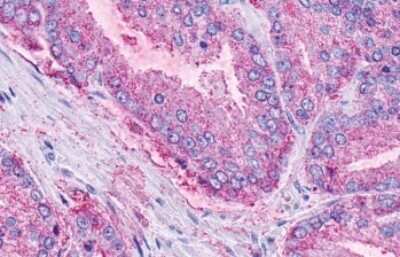 Immunohistochemistry-Paraffin: LPAR6/P2RY5 Antibody [NLS850] - Human Prostate, Carcinoma tissue after heat-induced antigen retrieval.