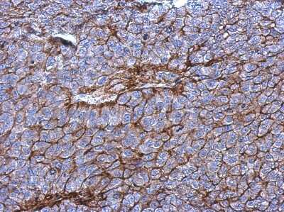 Immunohistochemistry-Paraffin: P2X3 Antibody [NBP2-19657] - Immunohistochemical analysis of paraffin-embedded PC14 xenograft, using antibody at 1:500 dilution.