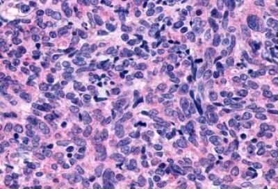 Immunohistochemistry-Paraffin: P2Y10/P2RY10 Antibody [NLS860] - Anti-P2Y10 / P2RY10 antibody IHC of human Lung, Small Cell Carcinoma. Immunohistochemistry of formalin-fixed, paraffin-embedded tissue after heat-induced antigen retrieval.