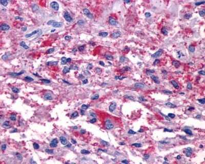 Immunohistochemistry-Paraffin: P2Y11/P2RY11 Antibody [NLS866] - Analysis of anti-P2RY11 / P2Y11 antibody with human brain, glioblastoma.